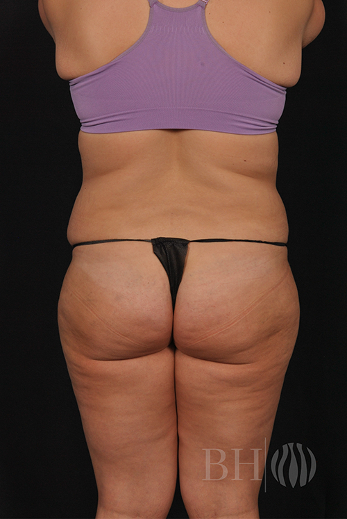 Breast Augmentation With Lift Before & After